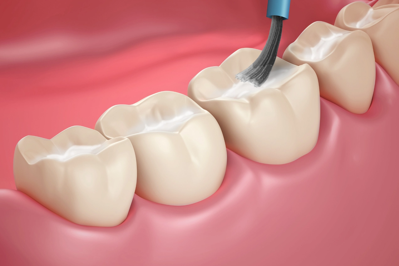 dental-sealants