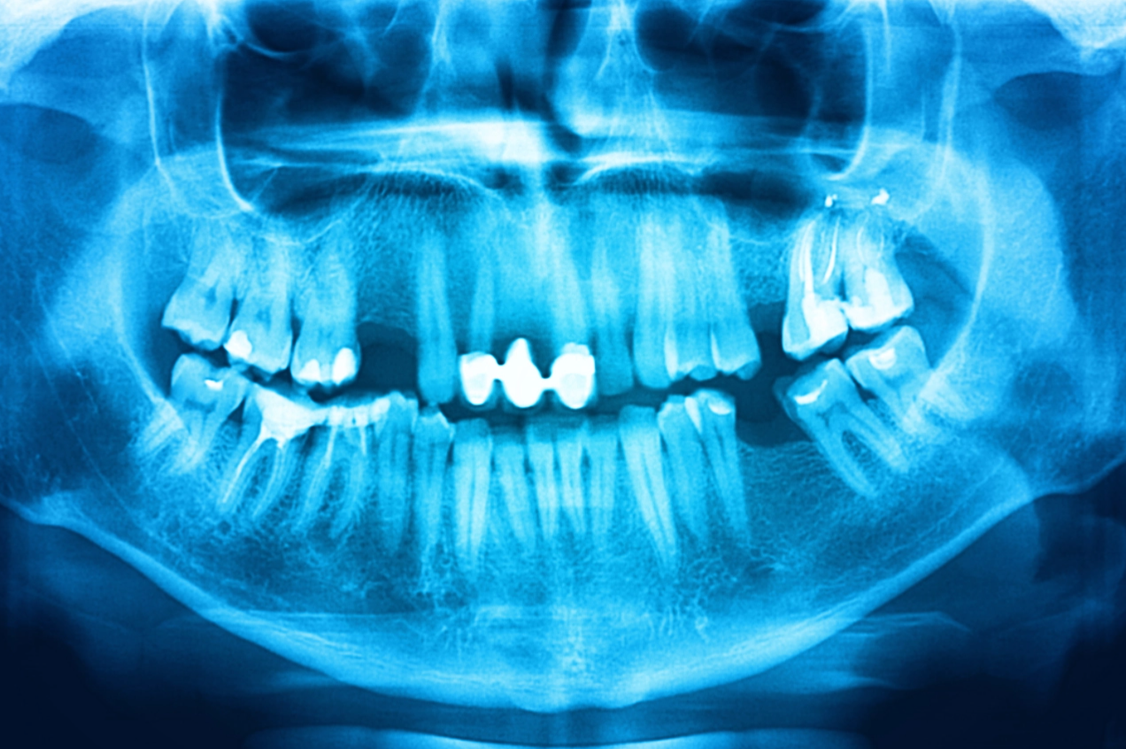digital-x-rays