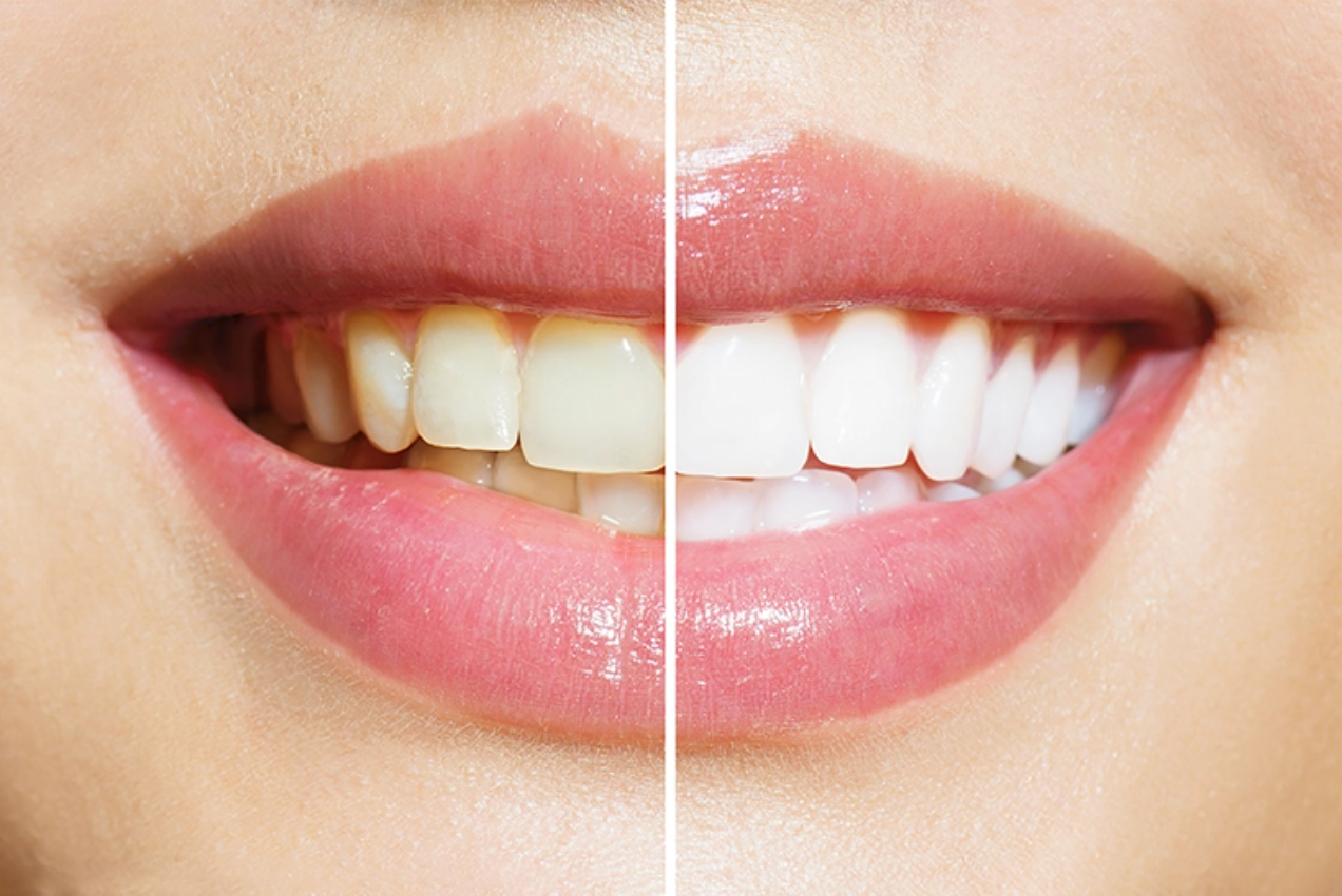in-office-whitening